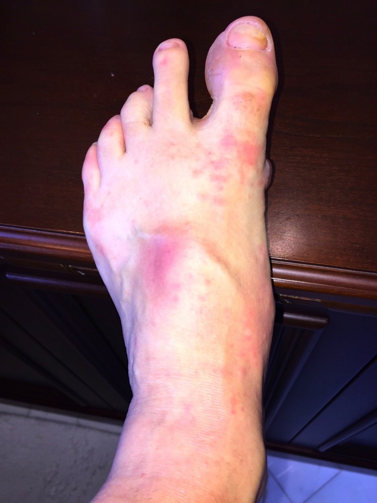 Blisters, a bruise on top of my foot, and a weird rash.